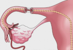 贵阳助孕中介群-单侧输卵管结扎的这六个后果不仅会影响到生育能力，也会影
